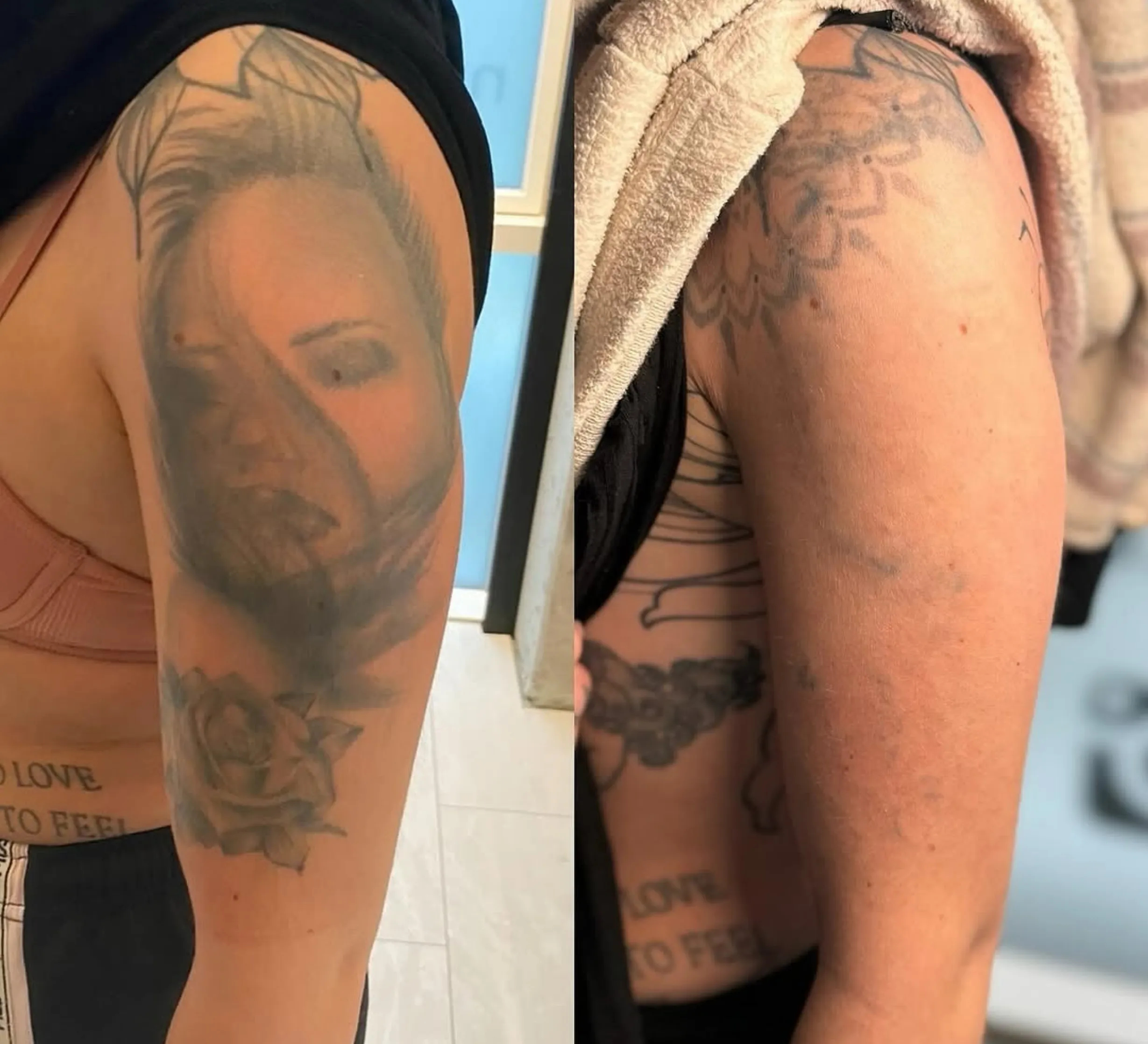 saline solution tattoo removal