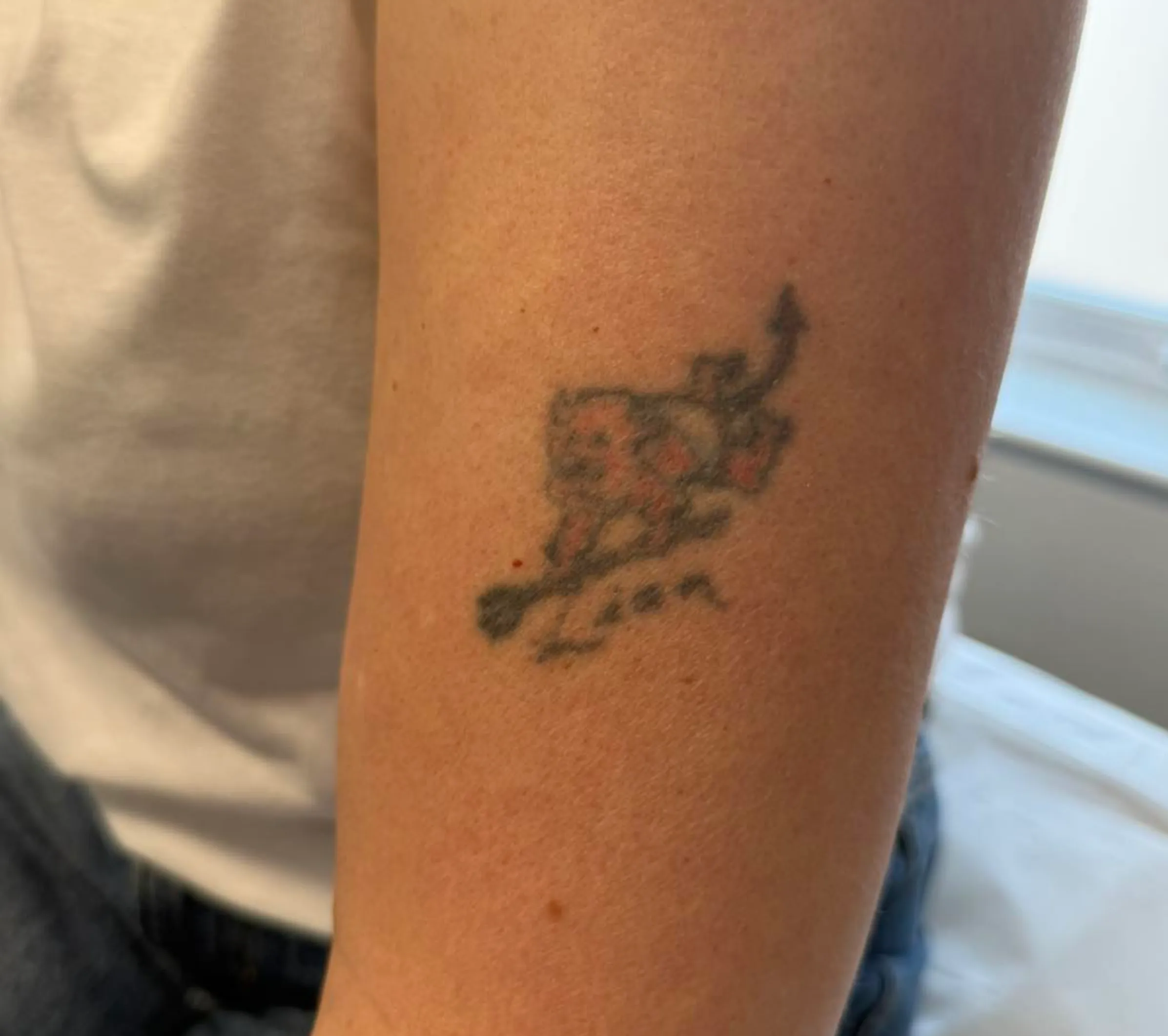 cosmetic tattoo pigment removal