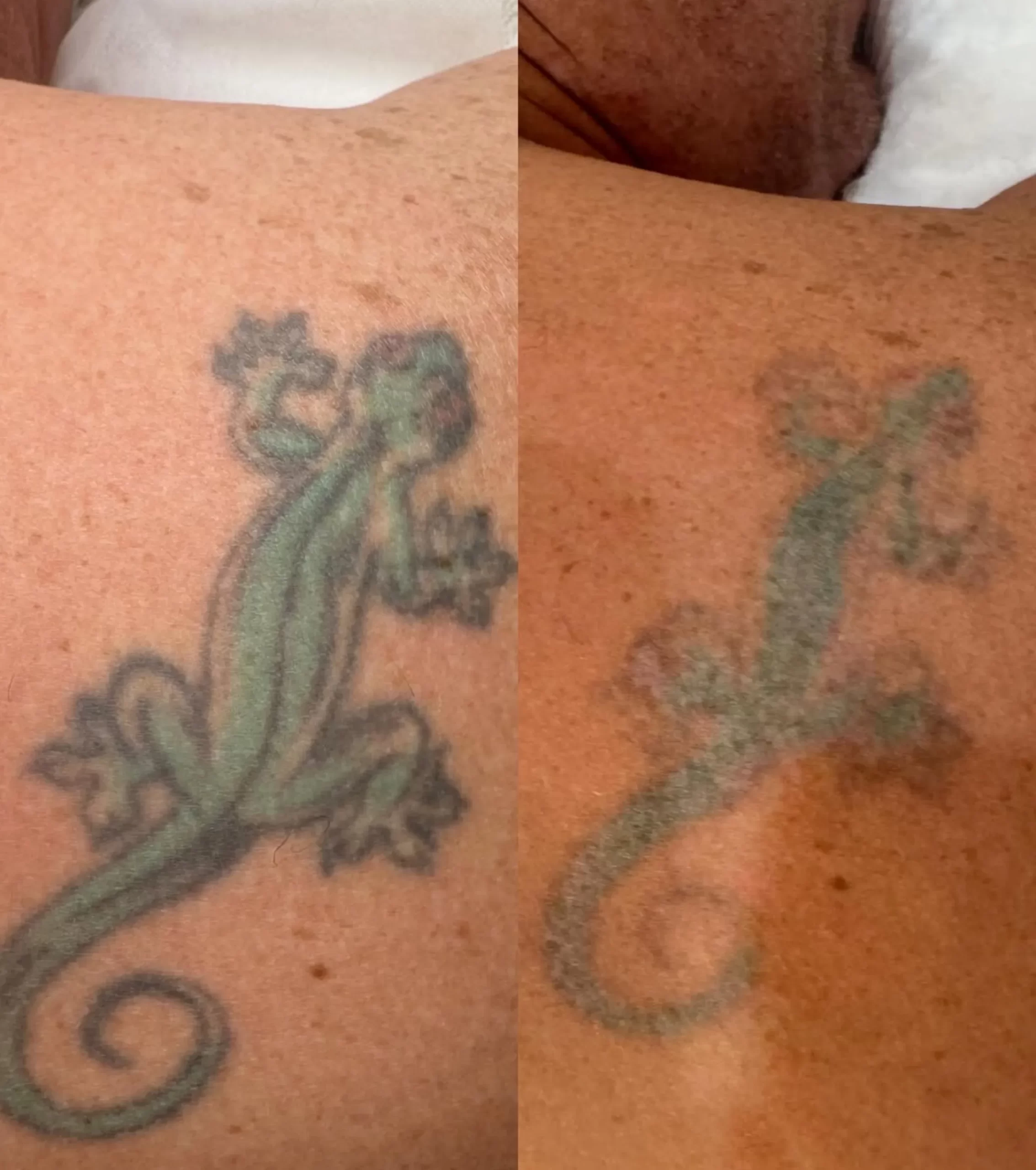 how tattoo ink is removed
