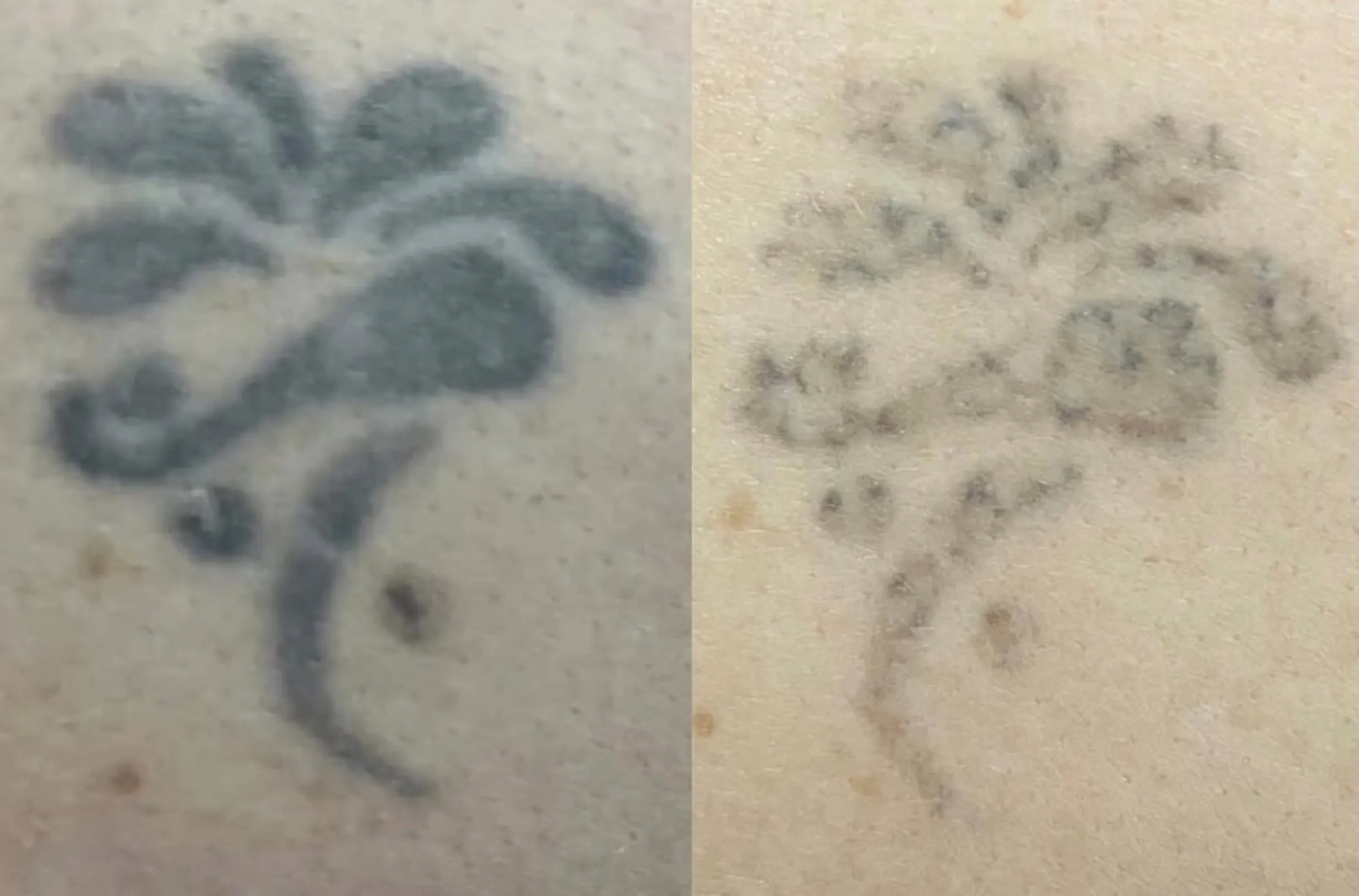 best way to remove tattoo ink