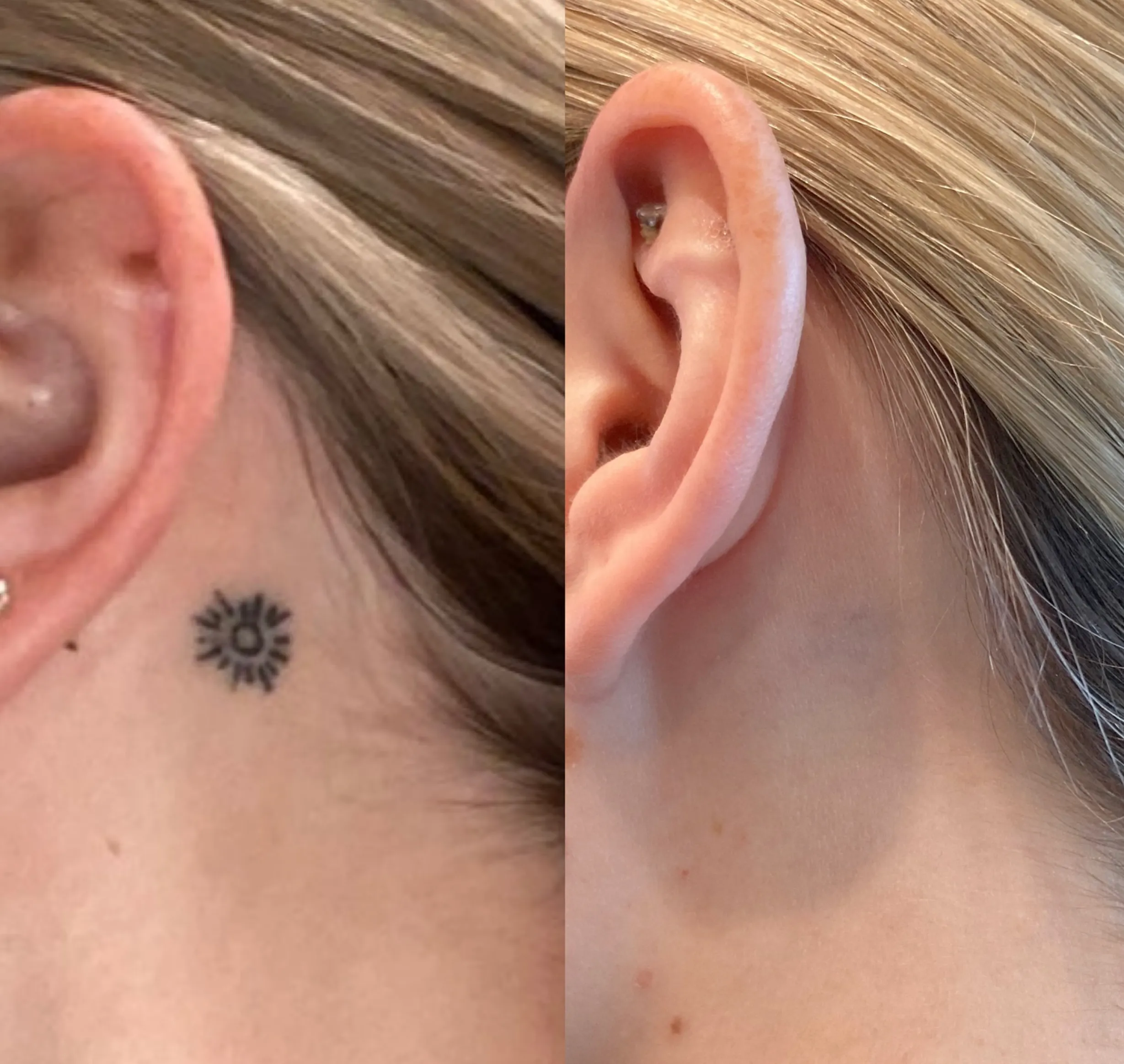 laser vs saline tattoo removal