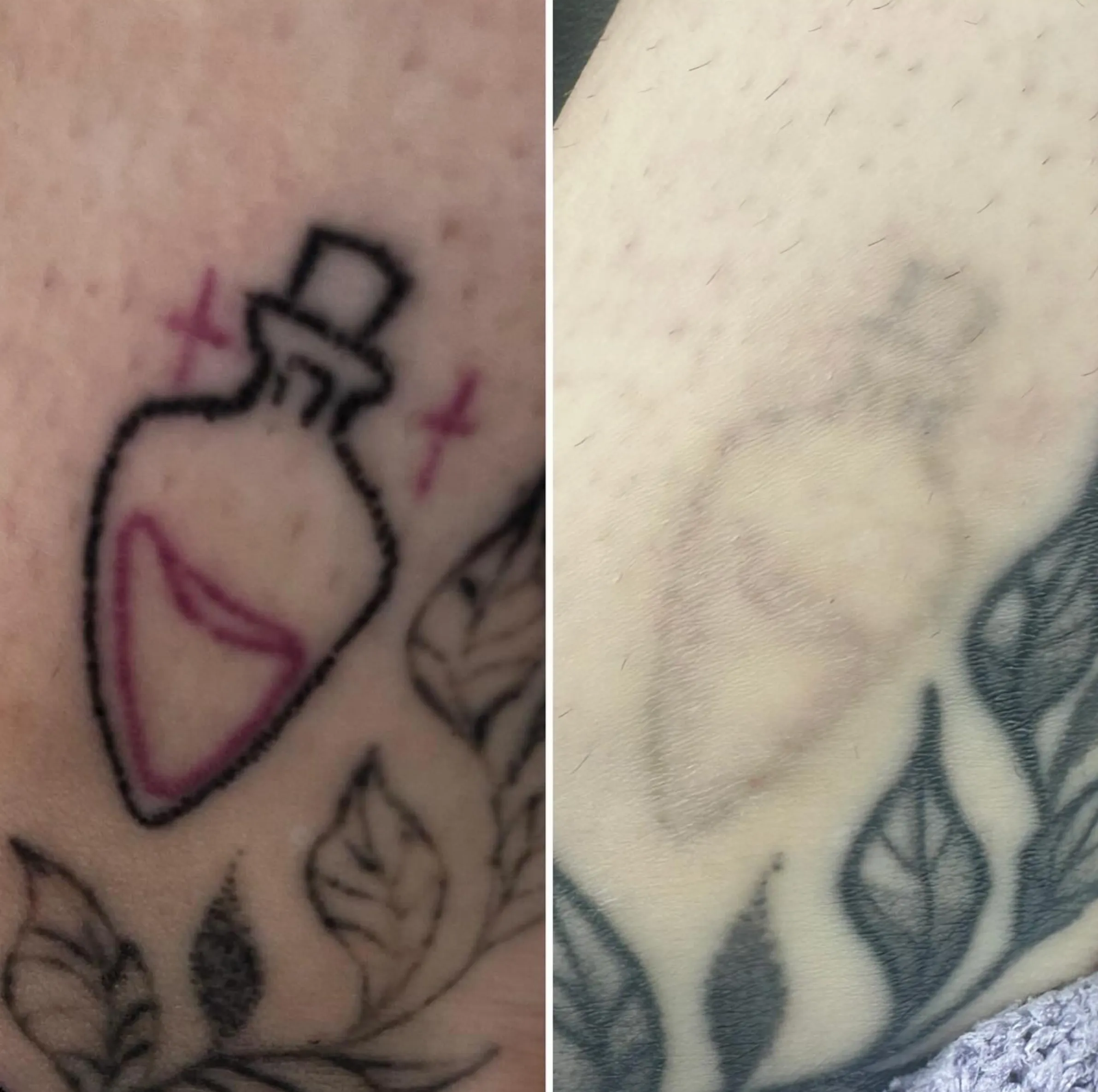 What pulls tattoo ink out?
